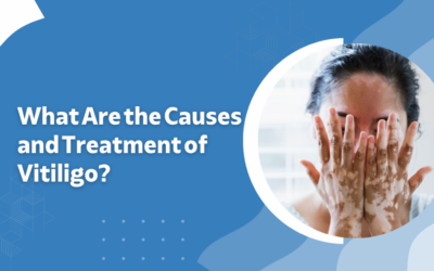 What Are the Causes and Treatment of Vitiligo?