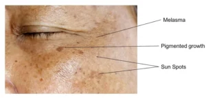 different types of skin pigmentation