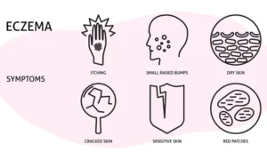 symptoms of eczema