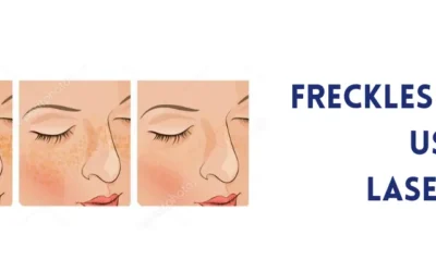 Freckles treatment using Laser Light