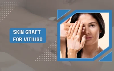 Skin Graft For Vitiligo