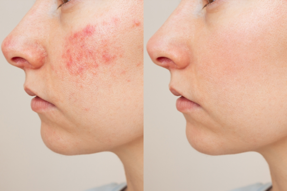 How to Tell If Eczema is Healing: Common Signs