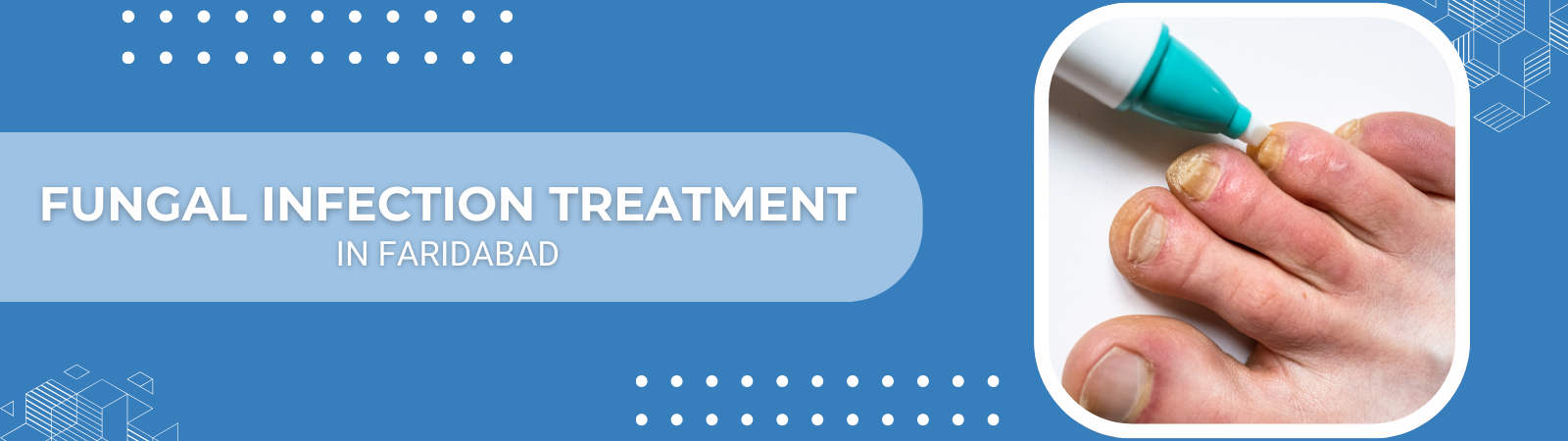 Fungal Infection Treatment Fungal Infection Treatment