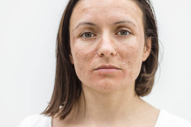 Signs that your chemical peel is working