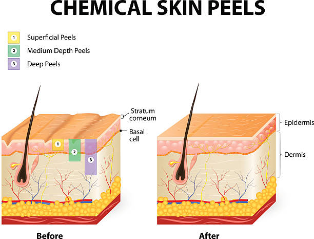 What happens on day 3 of chemical peel? What happens on day 3 of chemical peel?