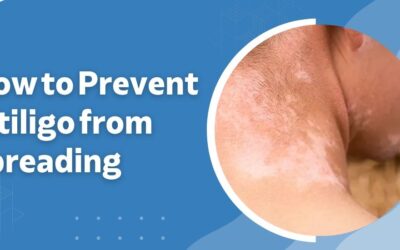 How to Prevent Vitiligo from Spreading: Expert Tips and Treatments