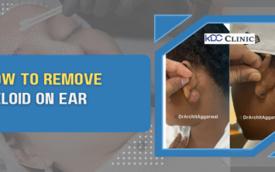 How to Remove Keloid on Ear