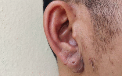 How to Remove Keloid on Ear