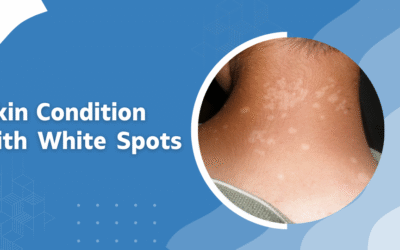 Skin Condition with White Spots