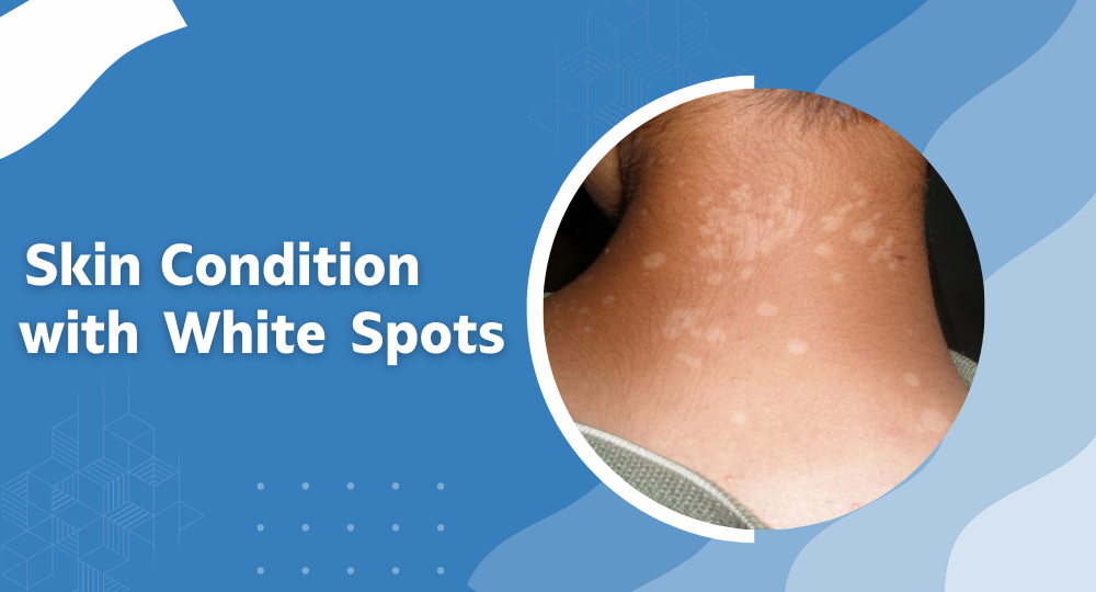 Skin condition with white spots
