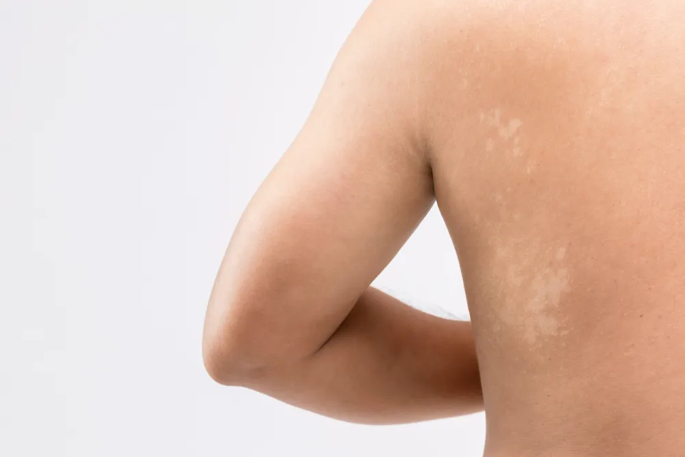 skin rash with white spots