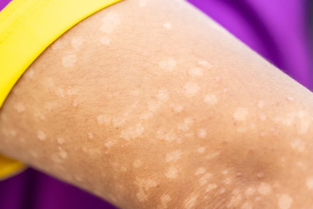 skin rash with white spots
