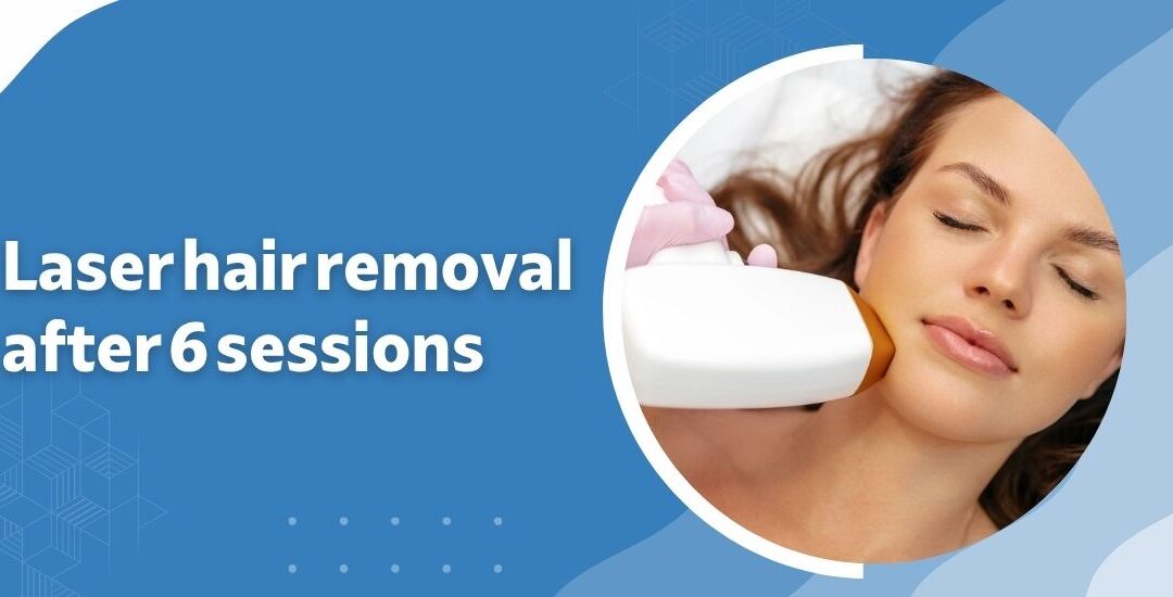Laser hair removal after 6 session