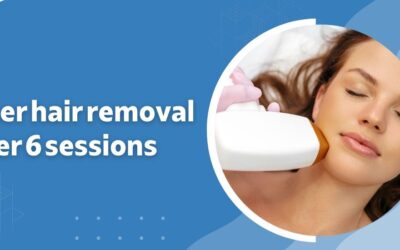 Laser hair removal after 6 sessions