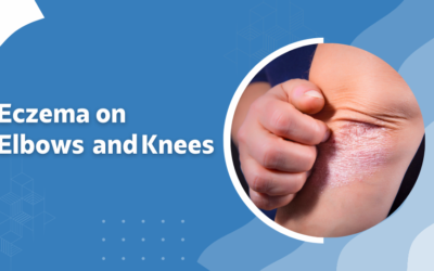 Eczema on Elbows and Knees: What to Expect and How to Care for Your Skin