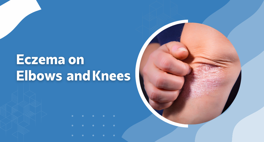eczema on elbows and knees