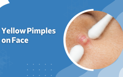Yellow Pimples on Face – Causes, Treatment, and When to Seek a Dermatologist