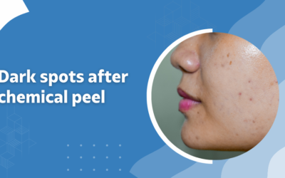 Dark spots after a chemical peel?
