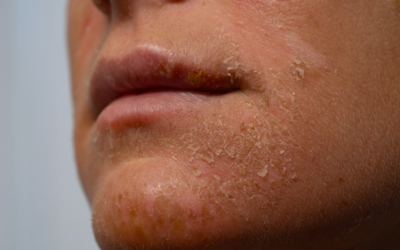 Dark spots after a chemical peel?