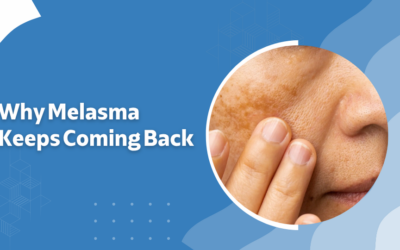  Why Melasma Keeps Coming Back?