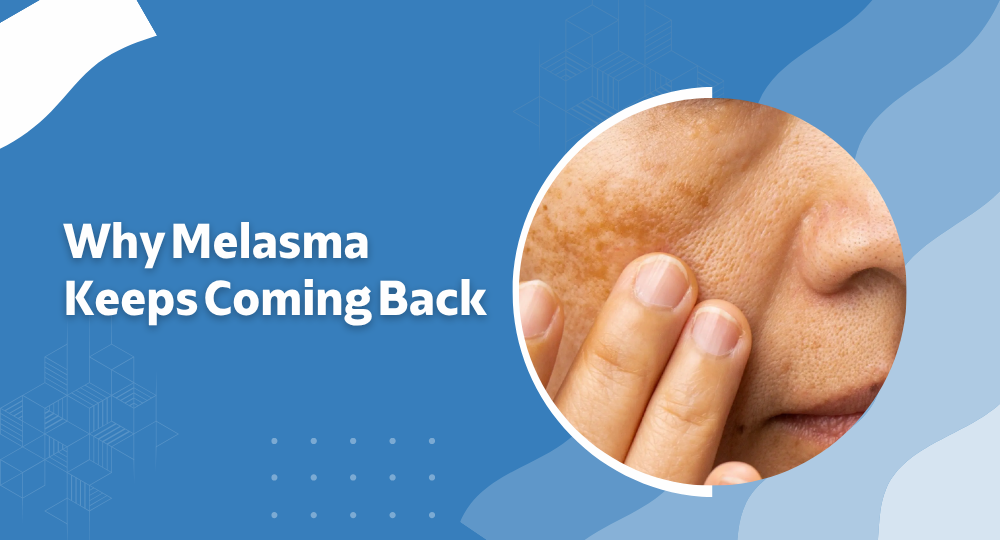Why Melasma Keeps Coming Back