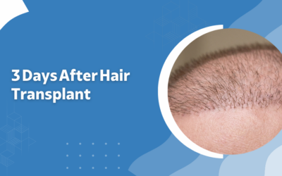 3 Days After Hair Transplant