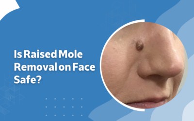 Is Raised Mole Removal on Face Safe?