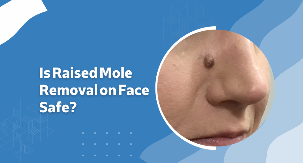 Is Raised Mole Removal on Face Safe