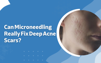 Can Microneedling Really Fix Deep Acne Scars?