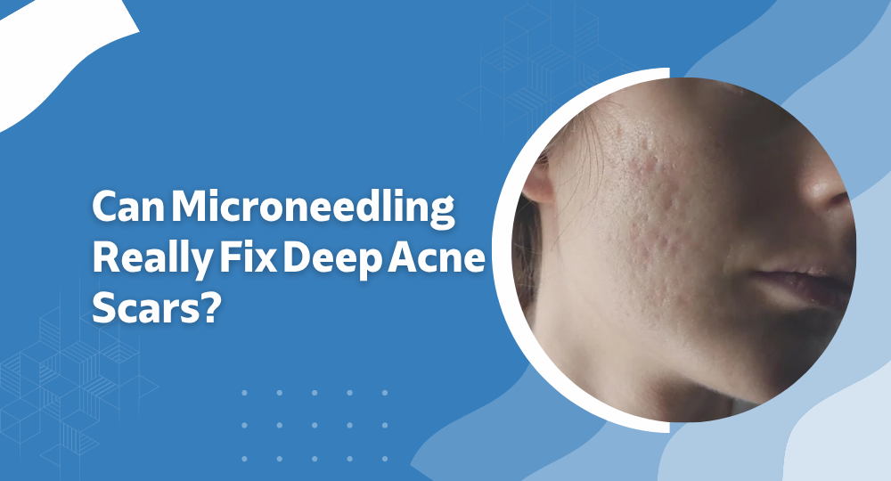 Can Microneedling Really Fix Deep Acne Scars