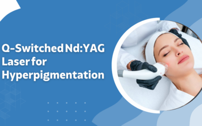 Q-Switched Nd:YAG Laser for Hyperpigmentation