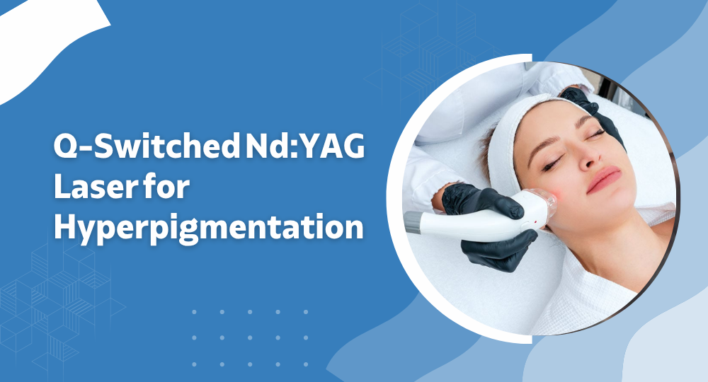 Banner with the title 'Q-Switched Nd:YAG Laser for Hyperpigmentation' and a woman receiving facial laser treatment in a circular frame on a blue abstract background.