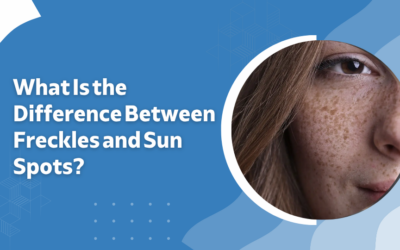 Freckles vs Sun Spots:What’s the Difference?