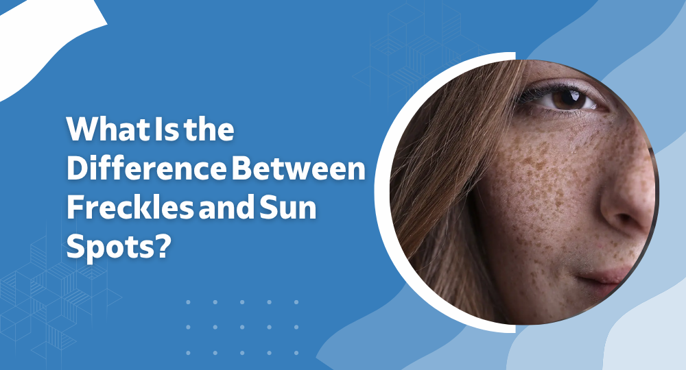 What Is the Difference Between Freckles and Sun Spots