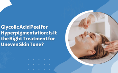 Glycolic Acid Peel for Hyperpigmentation