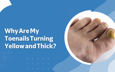 Why Are My Toenails Turning Yellow and Thick?
