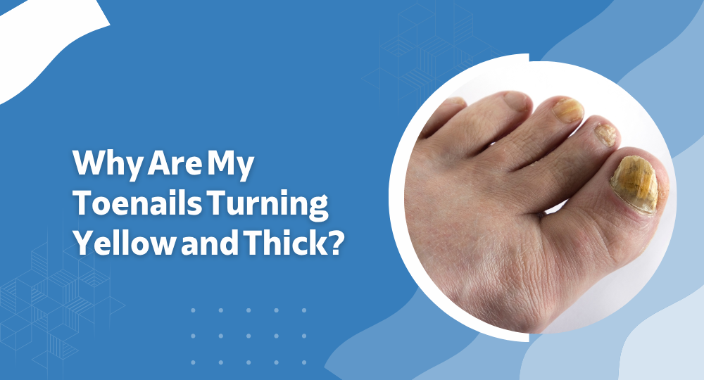Why Are My Toenails Turning Yellow and Thick