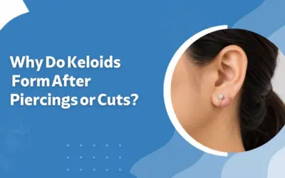 Why Do Keloids Form After Piercings or Cuts?