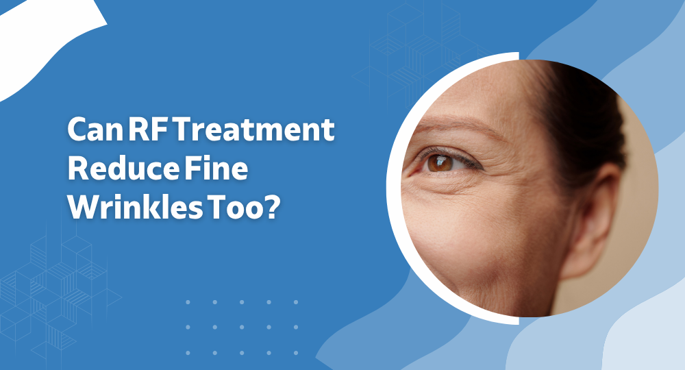 Can RF Treatment Reduce Fine Wrinkles Too