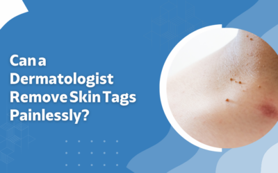 Can a Dermatologist Remove Skin Tags Painlessly?