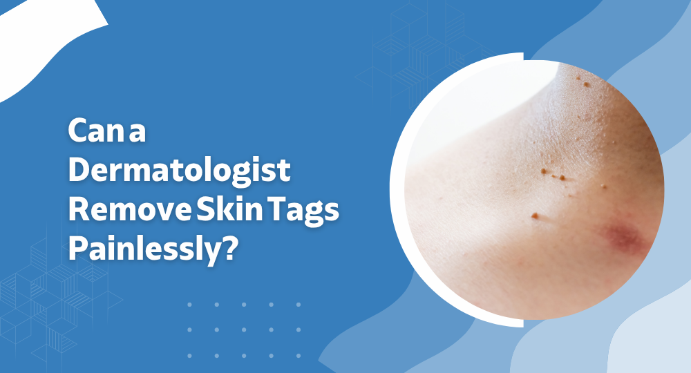 Can a Dermatologist Remove Skin Tags Painlessly