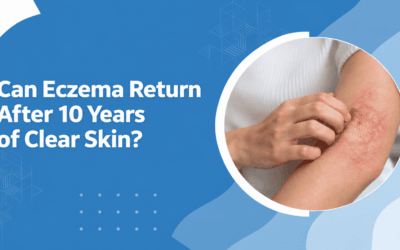 Can Eczema Return After 10 Years of Clear Skin?